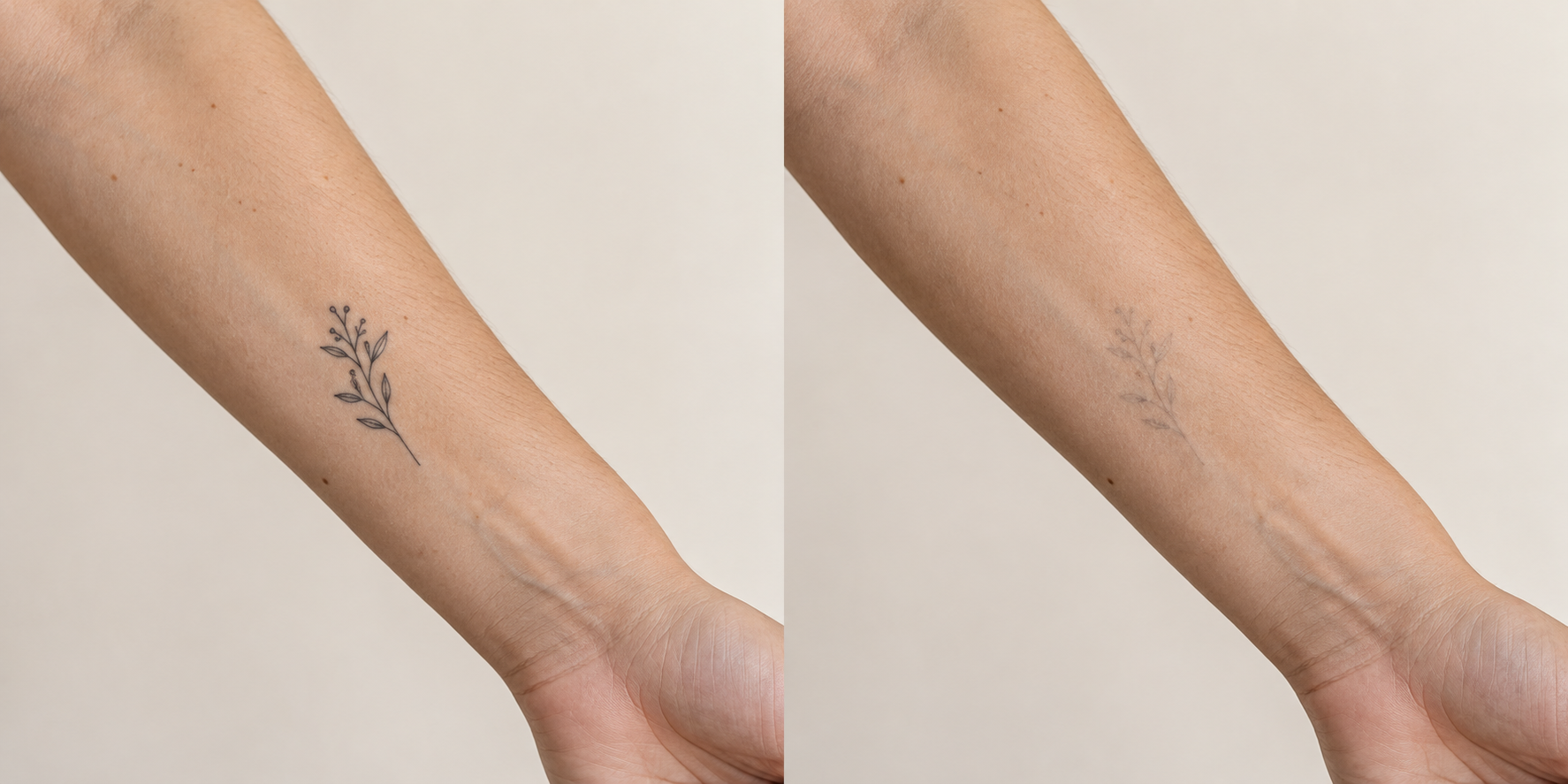 Illustration générée par IA : comparaison fictive d’un tatouage avant et après son atténuation